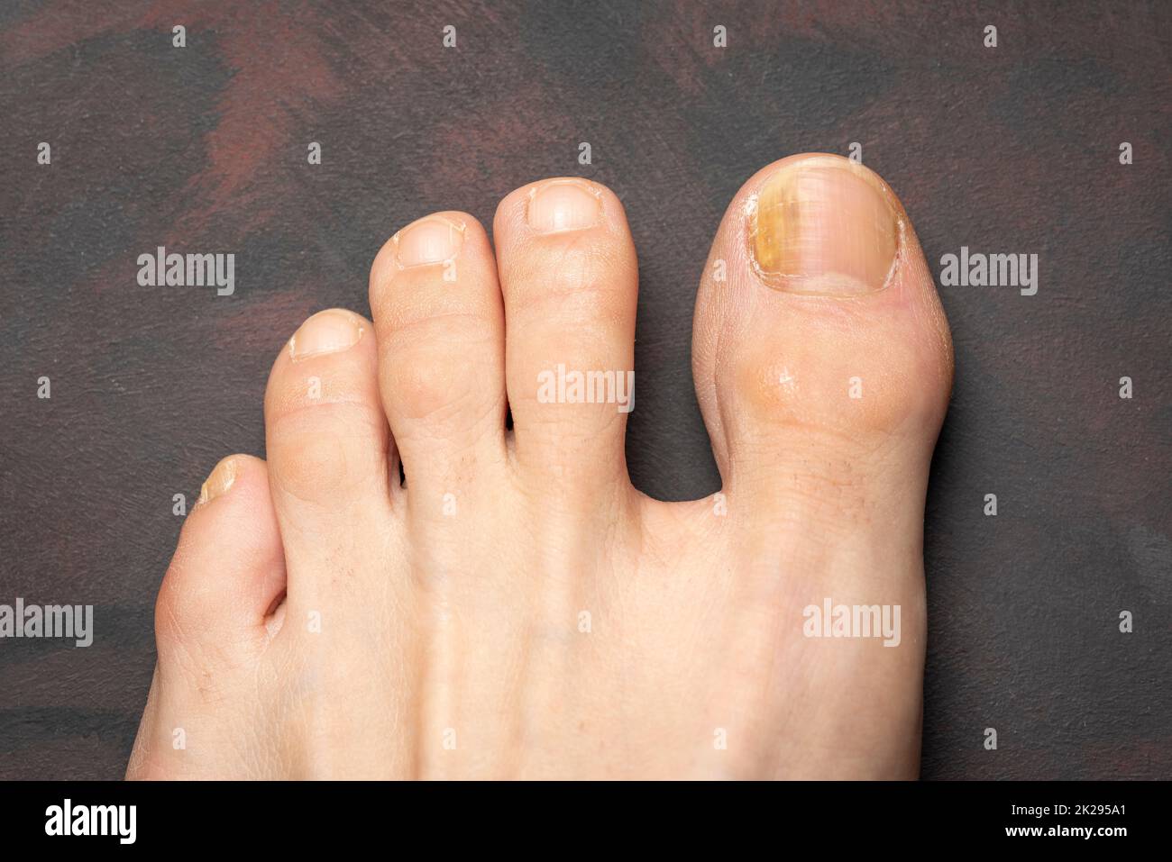 Fungal infection nail hi-res stock photography and images - Page 2 - Alamy Fungal infection nail hi-res stock photography and images - Page 2 - Alamy
