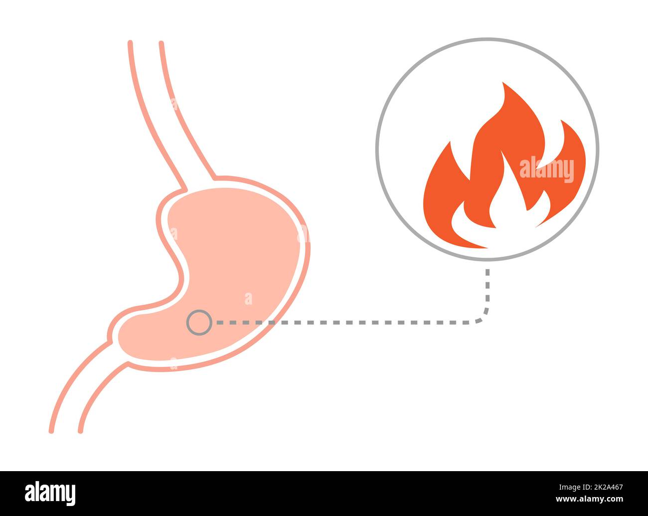Acid reflux disease concept. Human stomach on fire, cut view. Vector illustration in flat style Stock Photo