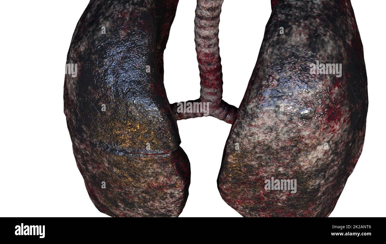Human lungs of smoker Stock Photo
