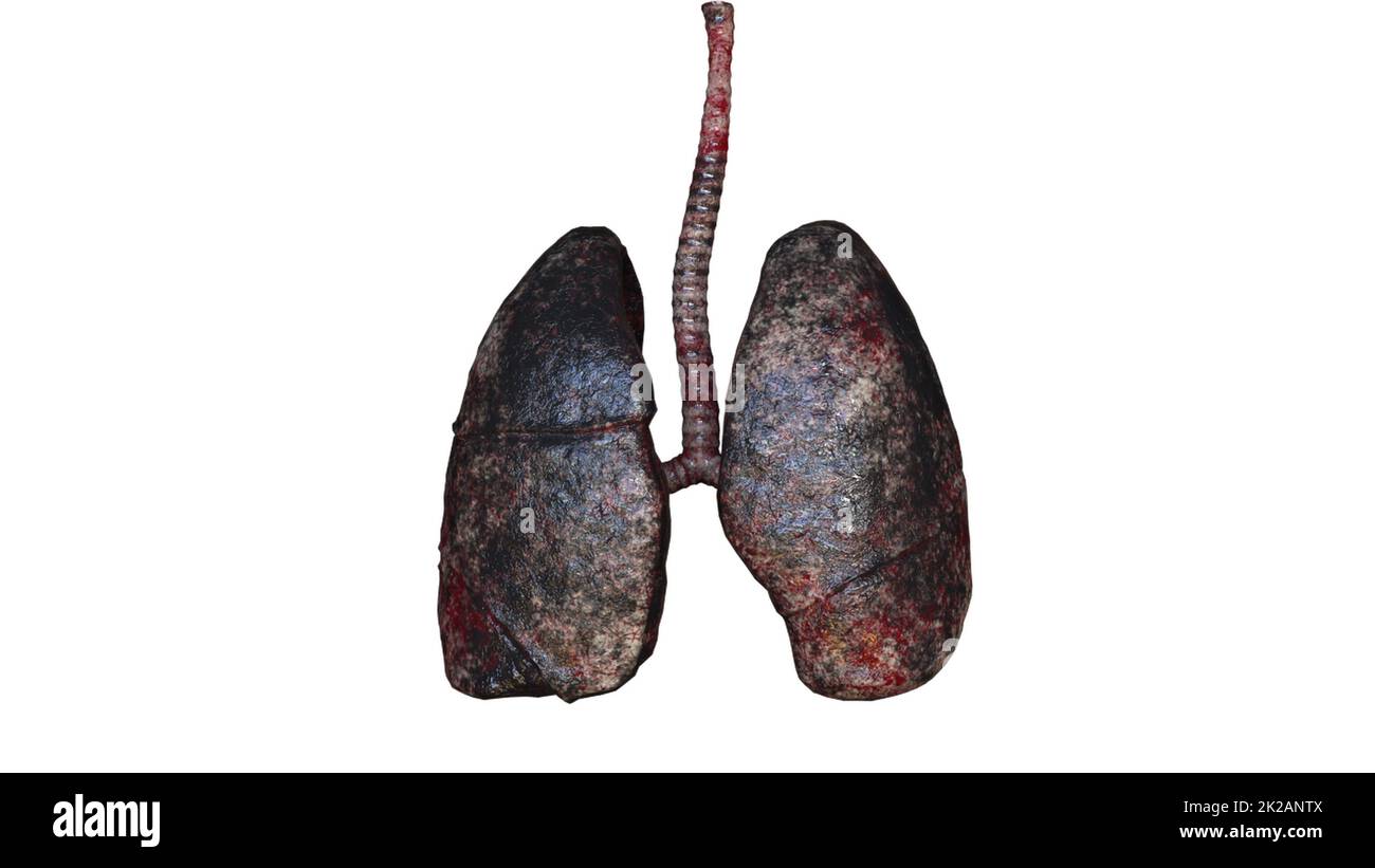 Human lungs of smoker Stock Photo