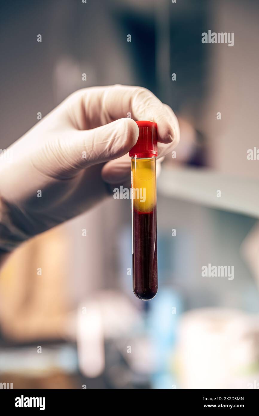 Extraction of plasma from blood Stock Photo