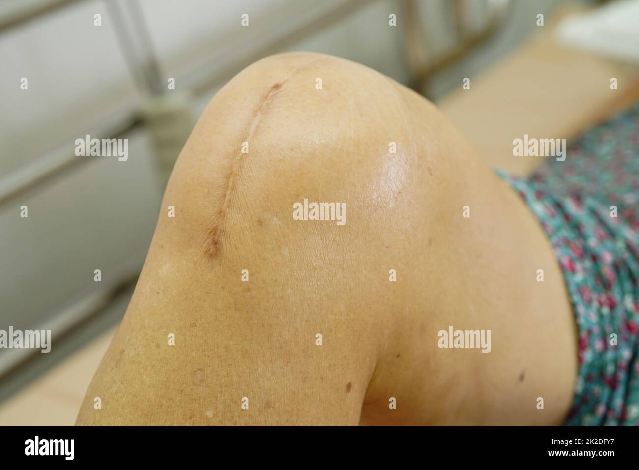 Asian elderly woman patient with scar knee replacement surgery in hospital. Stock Photo