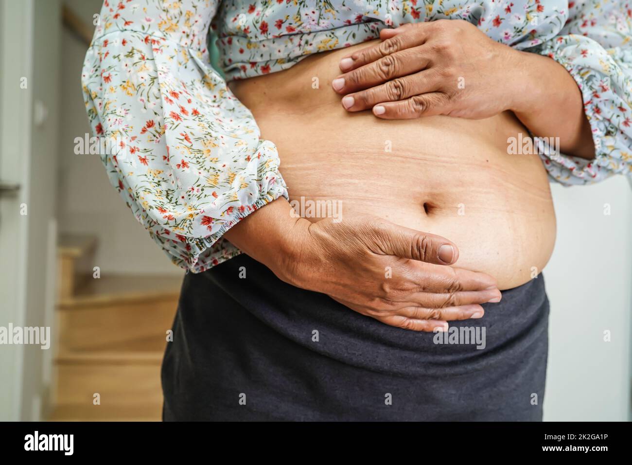 Woman grabbing skin on her flanks with black color crosses marking, Lose  weight and liposuction cellulite removal concept, Isolated on white  backgroun Stock Photo - Alamy