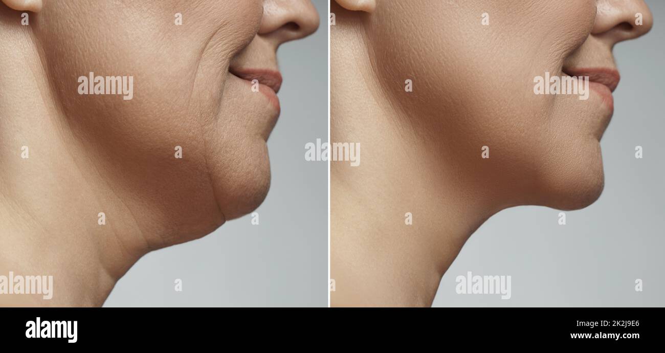 Double chin removal, facelift and neck liposuction Stock Photo