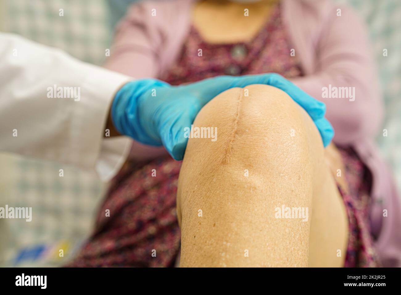 Asian elderly woman patient with scar knee replacement surgery in hospital. Stock Photo