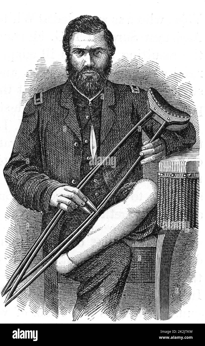 American Civil War 1861-1865. Casualty displaying the healed stump after removal of his foot by Pirogof amputation. Wood engraving 1865. Stock Photo