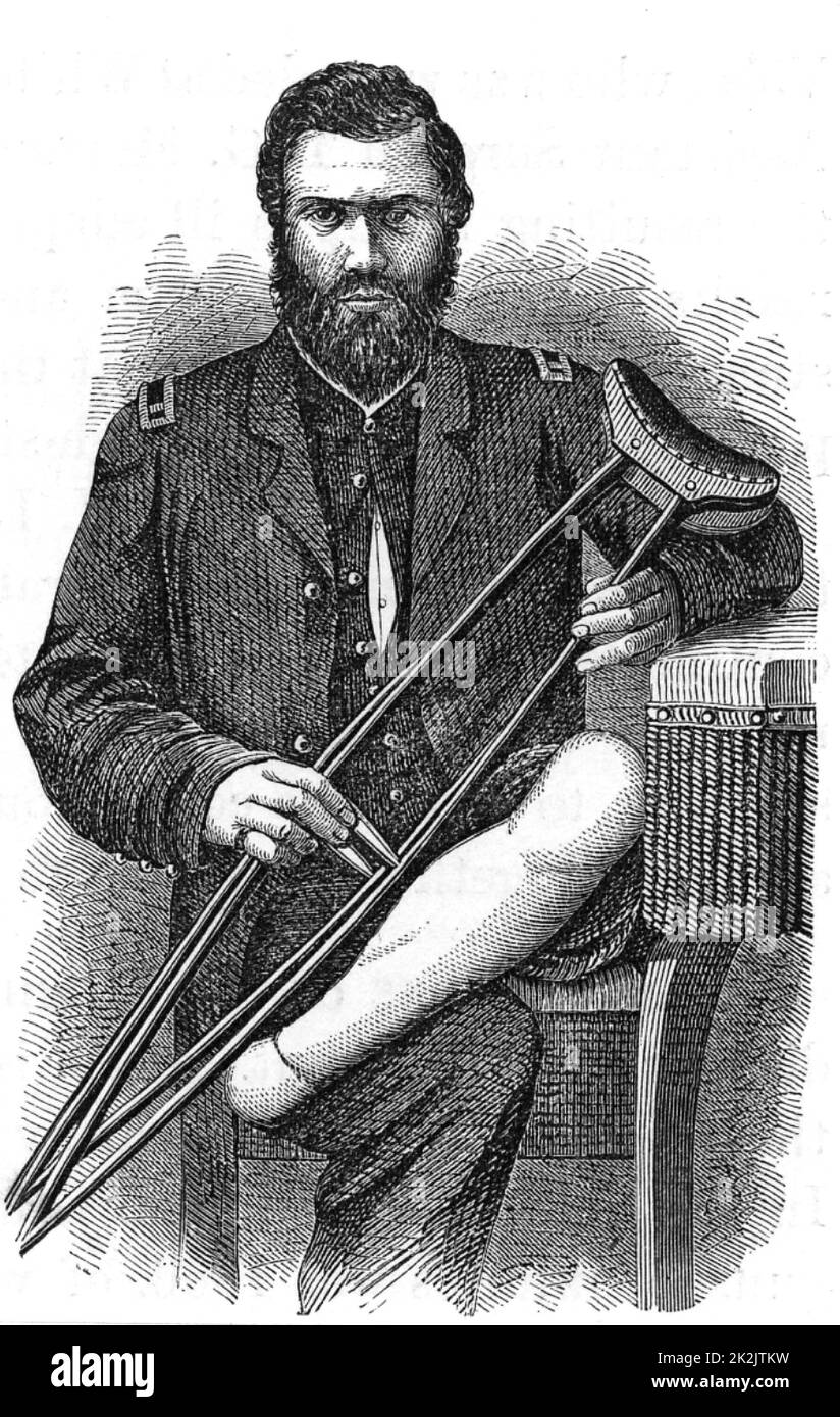 American Civil War 1861-1865. Casualty displaying the healed stump after removal of his foot by Pirogof amputation. Wood engraving 1865. Stock Photo