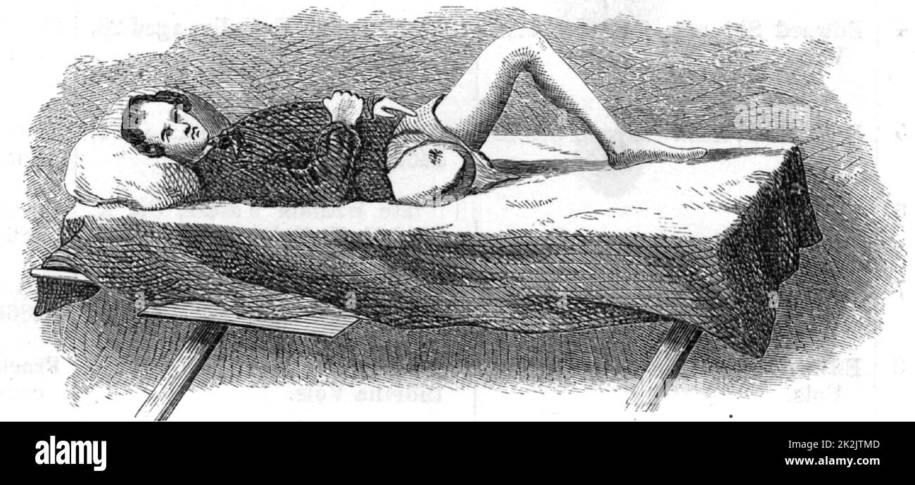 American Civil War 1861-1865. Casualty displaying healed stump after removal of his leg at the hip joint. Wood engraving 1865. Medicine. Field surgery. Amputation. Stock Photo