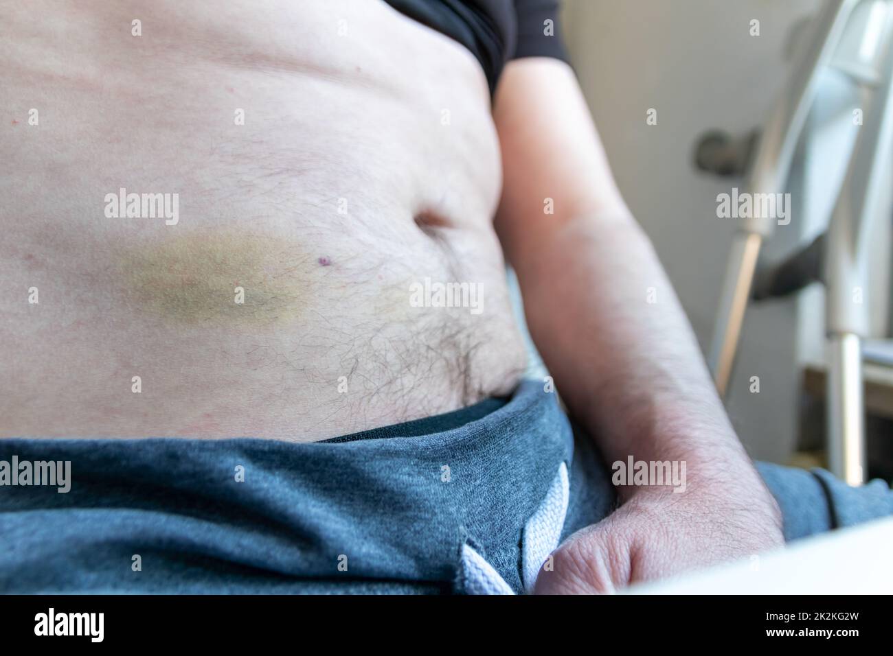 European man with Achilles tendon rupture after rupture operation self-injects enoxaparin or dalteparin in his belly subcutaneously with prefabricated syringe to avoid thrombosis myocardial infarction Stock Photo