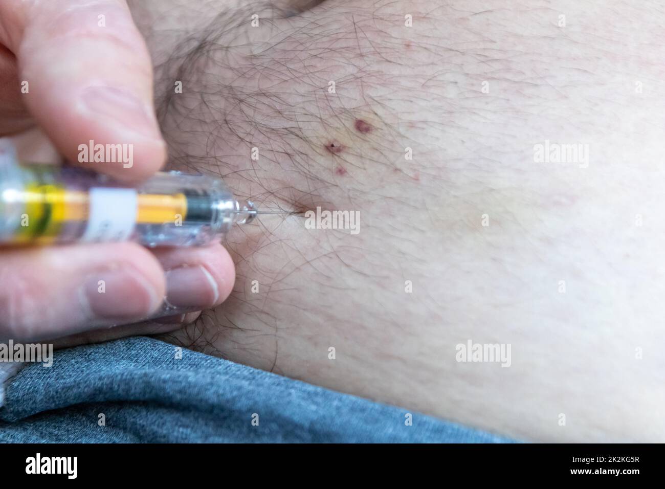 European man with Achilles tendon rupture after rupture operation self-injects enoxaparin or dalteparin in his belly subcutaneously with prefabricated syringe to avoid thrombosis myocardial infarction Stock Photo