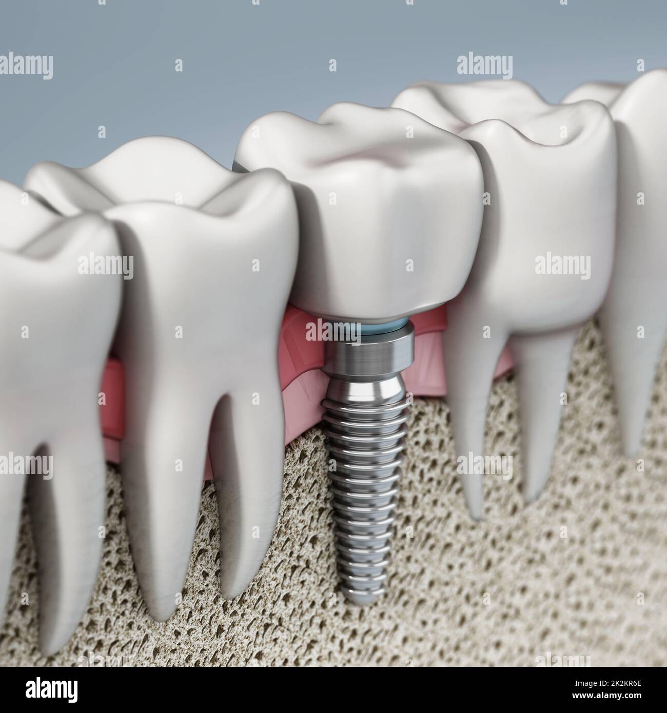 3D rendering of tooth implant showing jaw gum and bone layers. 3D