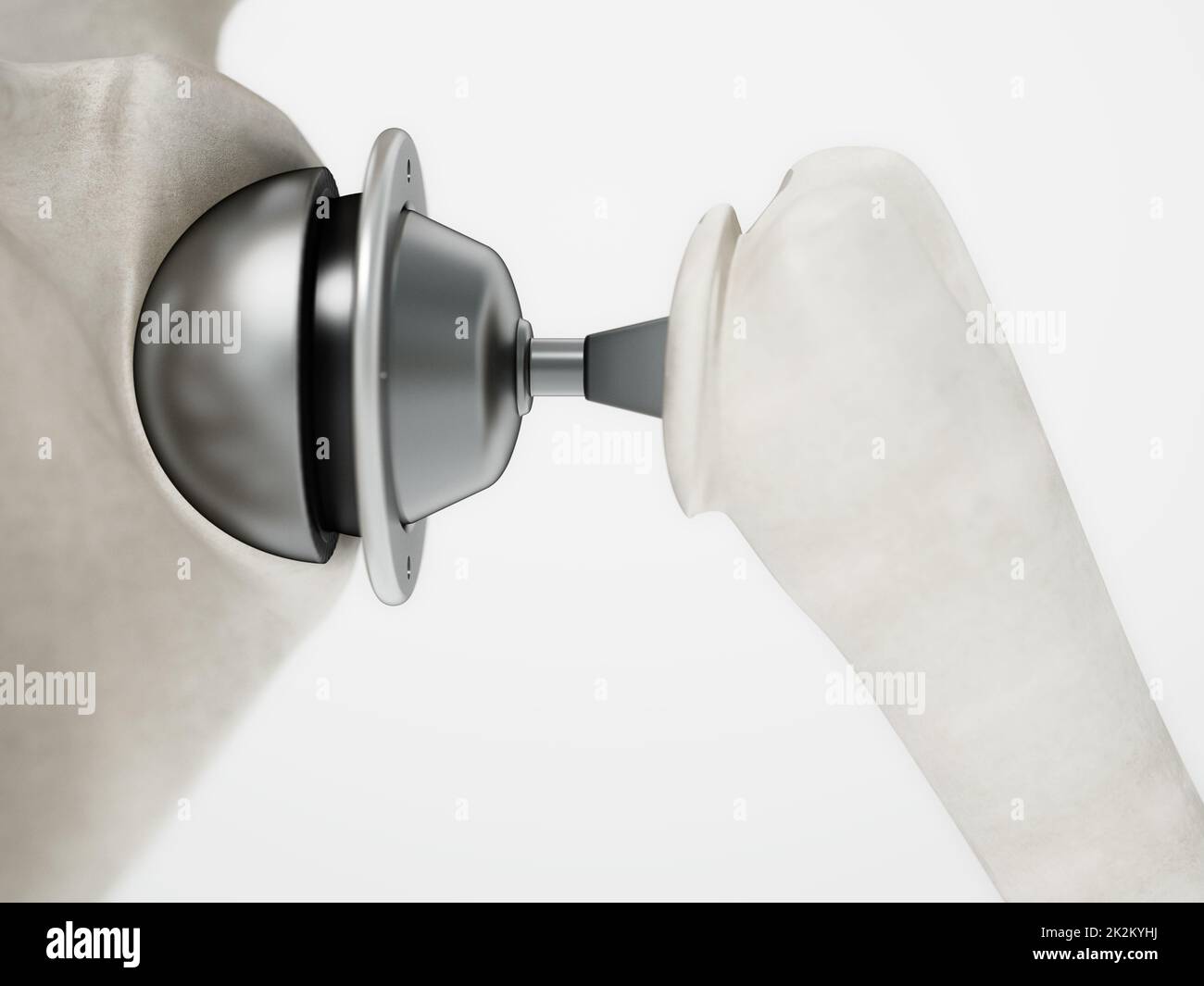 3D illustration of shoulder replacement surgery. 3D illustration Stock Photo