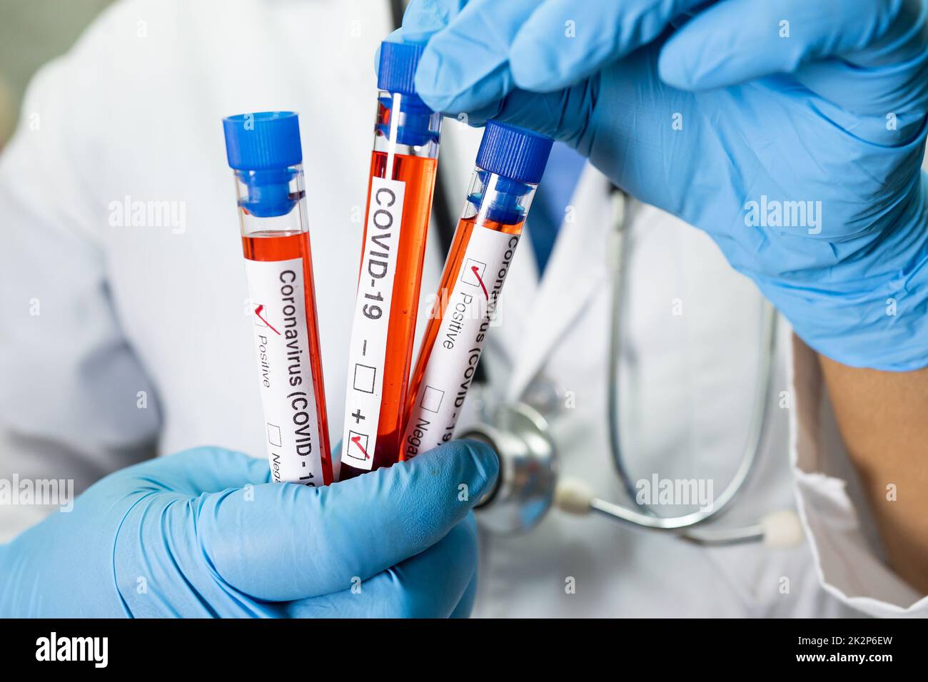 Positive blood infection sample in test tube for covid19 coronavirus