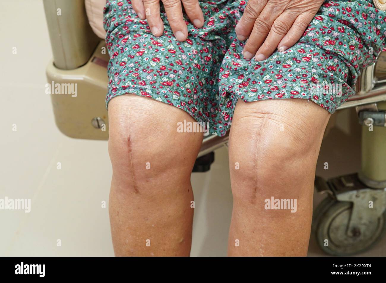 Asian elderly woman patient with scar knee replacement surgery in hospital. Stock Photo