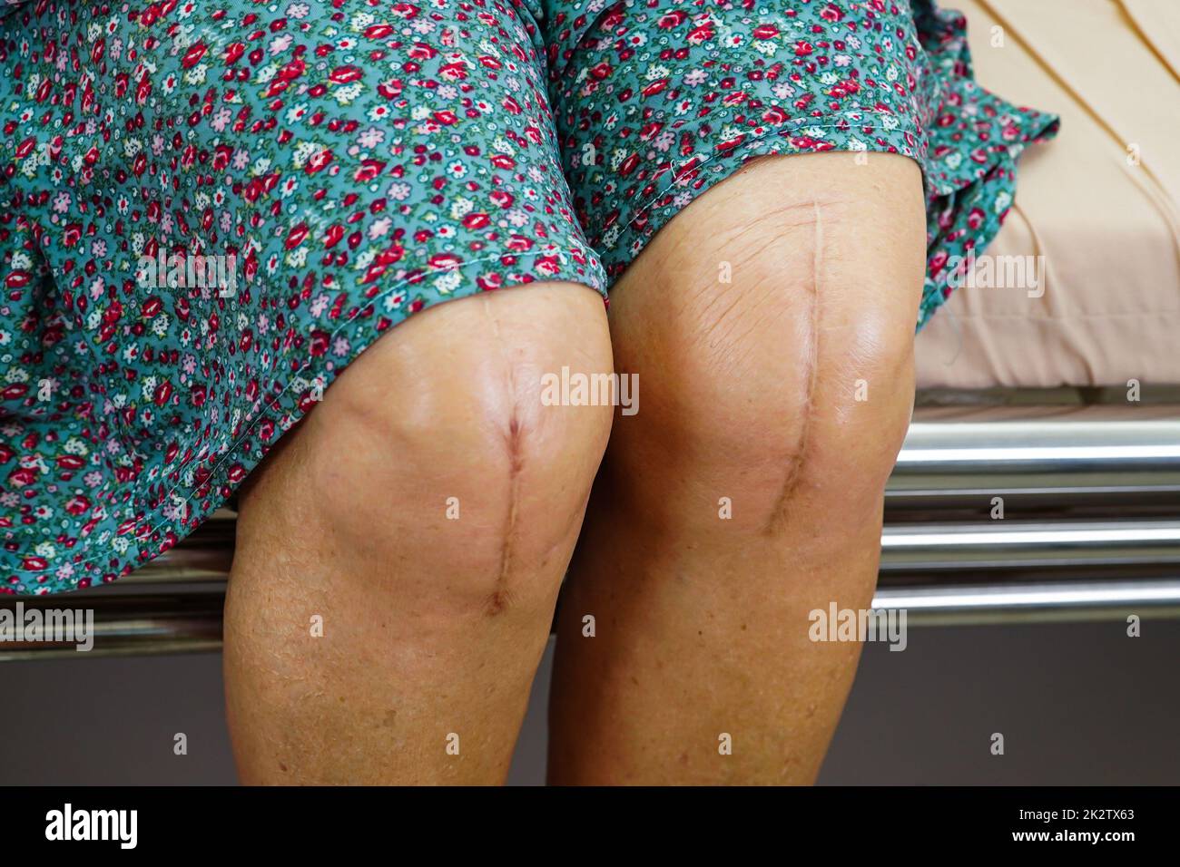 Asian elderly woman patient with scar knee replacement surgery in hospital. Stock Photo