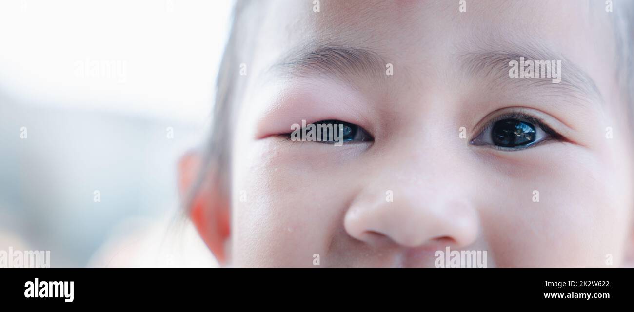 Stye Eye diseases. Closed Asian kid little girl eye with sty, eyelid
