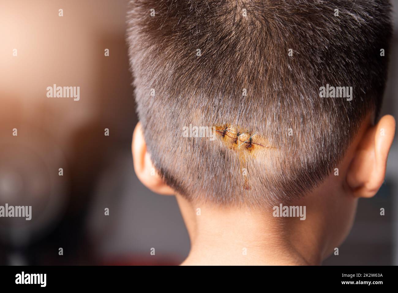 The lacerated suture wound of head which suture by nylion suture about 3 stitches Stock Photo