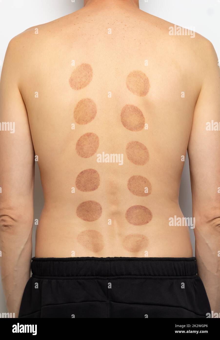 An imprint of a silicone vacuum massage jar on a patient's back. Stock Photo