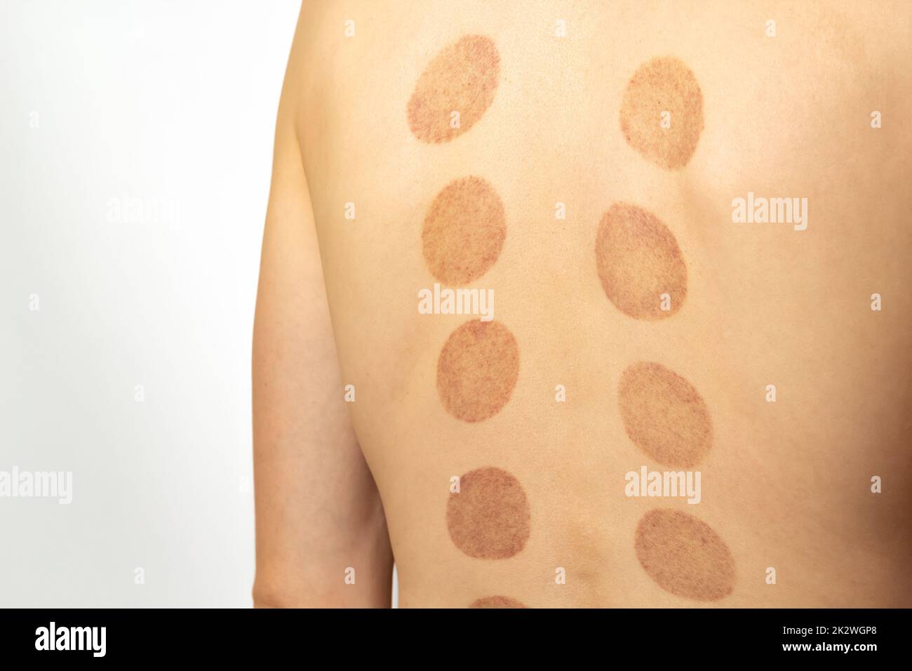 An imprint of a silicone vacuum massage jar on a patient's back. Stock Photo