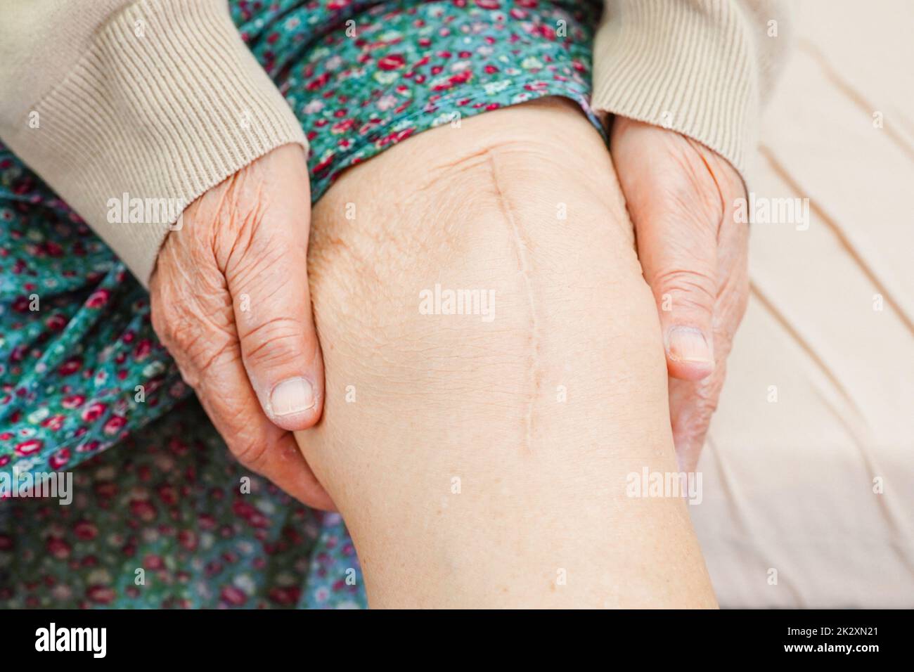 Asian elderly woman patient with scar knee replacement surgery in hospital. Stock Photo