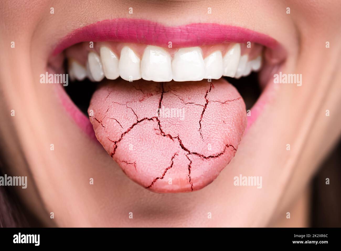 Dry Tongue Pain And Cracks Stock Photo