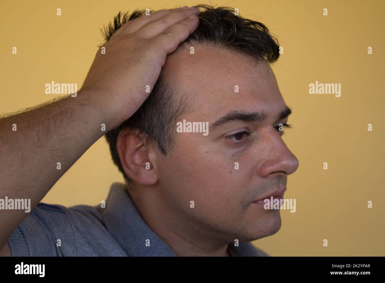 Image of a man showing the onset of hair loss and the principle of receding hairline. Possible causes and remedies for hair loss Stock Photo