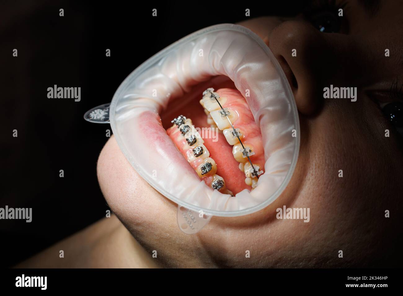 Close-up of teeth with metal braces. Orthodontic treatment of the jaw ...