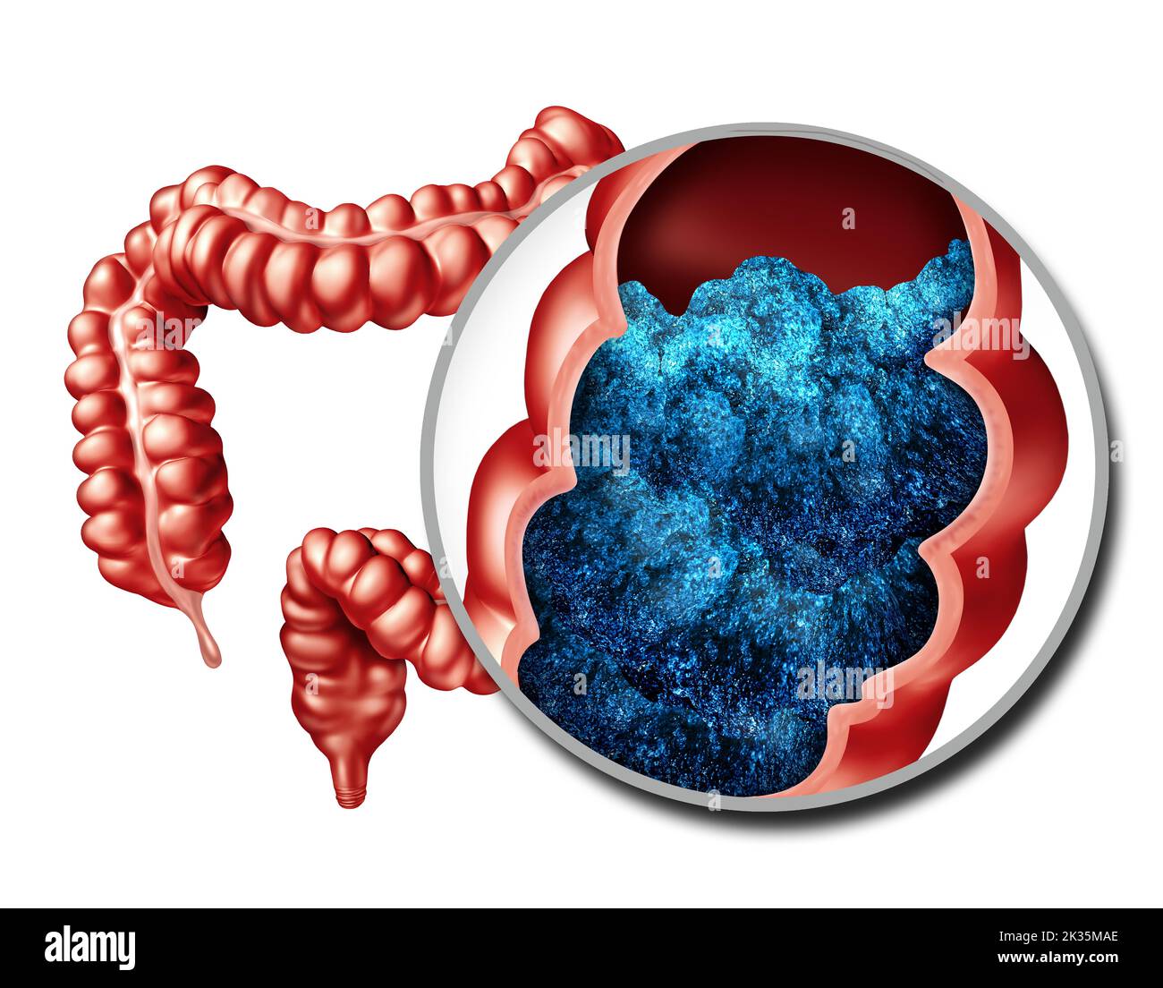 Intestine Bloating And constipation anatomy or constipated symptoms as stool bowel movement problem of a digestive system as a gastrointestinal Stock Photo