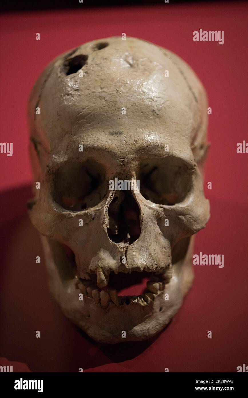 Trepanned human skull Stock Photo