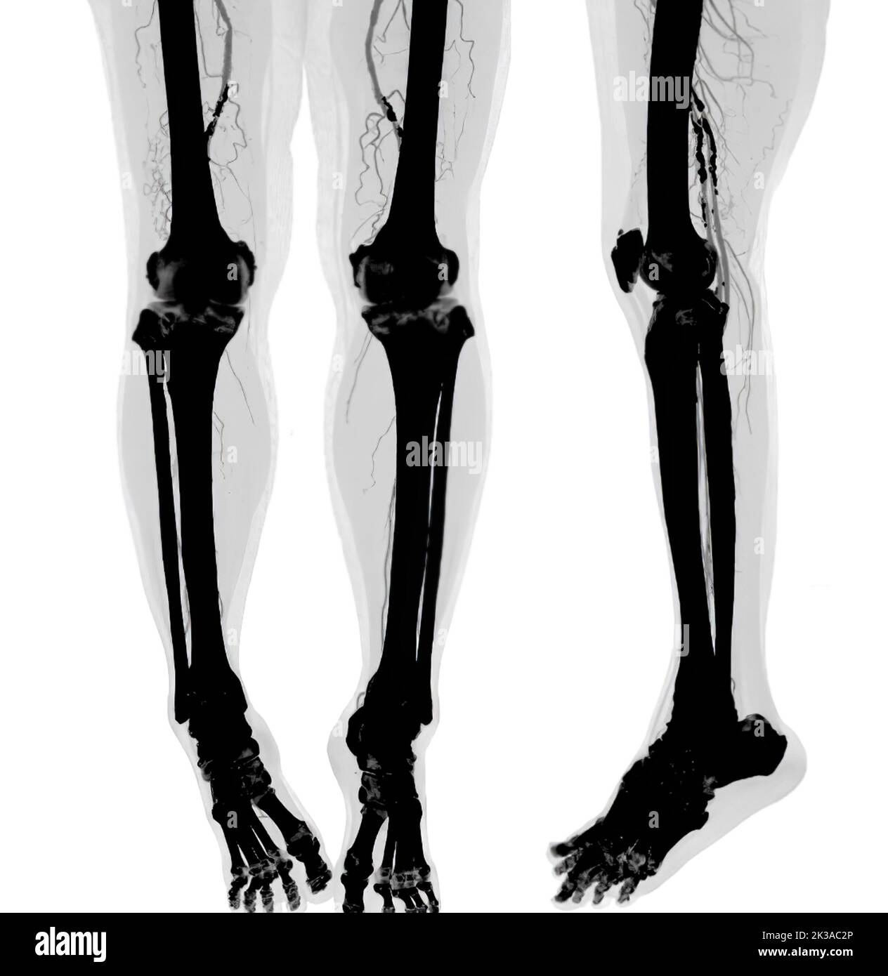 CTA femoral artery run off image of femoral artery Presenting with