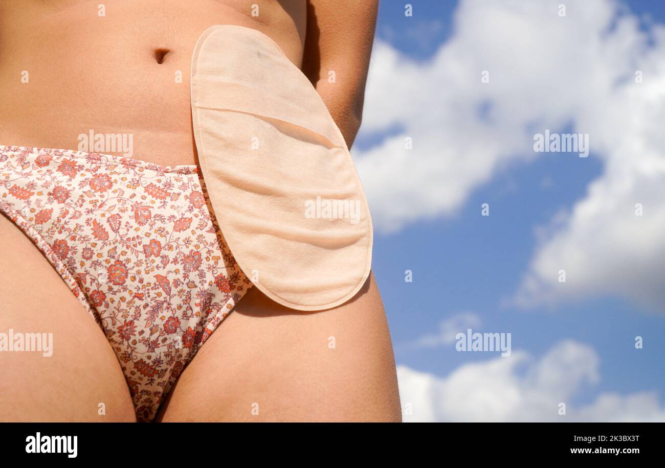 woman body with ostomy bag in bikini with the sky in the background