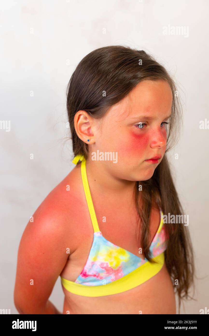 Sad little girl stand half turn with severe red burns on face and body after spending time in sun. Child in yellow swimsuit suffer from pain on Stock Photo