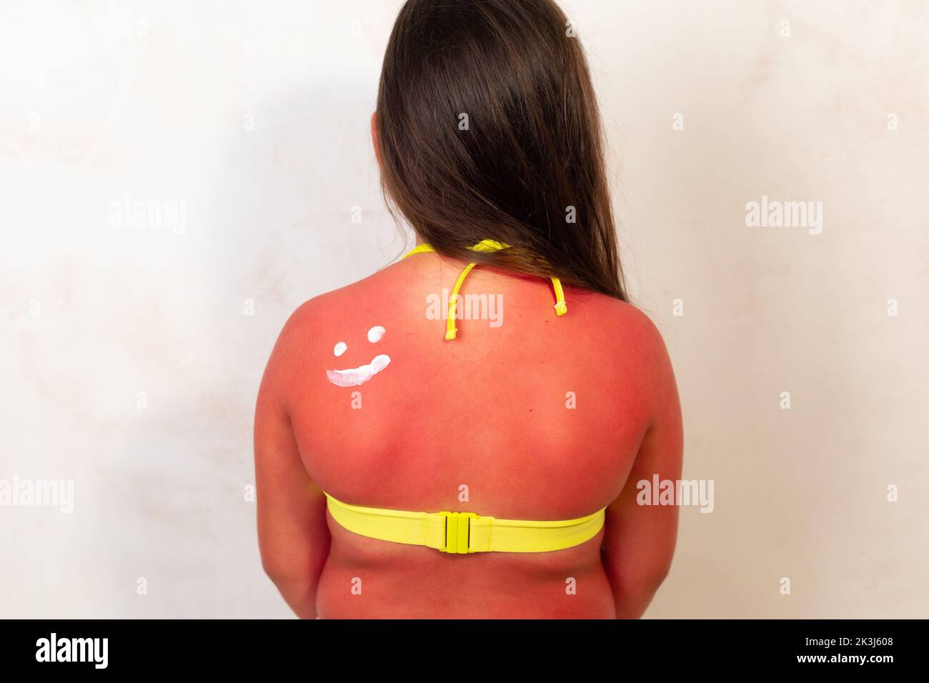 Back of girl with severe red burns after spending time in sun, gray background. Child in yellow swimsuit applying after sun cream on inflamed areas of Stock Photo