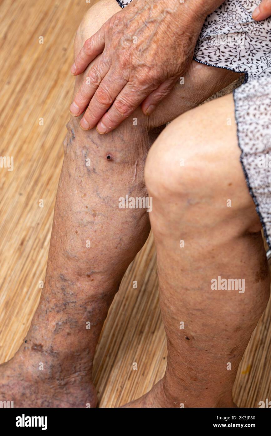 Senior woman sitting with bare legs, touching protruding varix. Need surgeon for blood vessels. Cosmetology treatment Stock Photo
