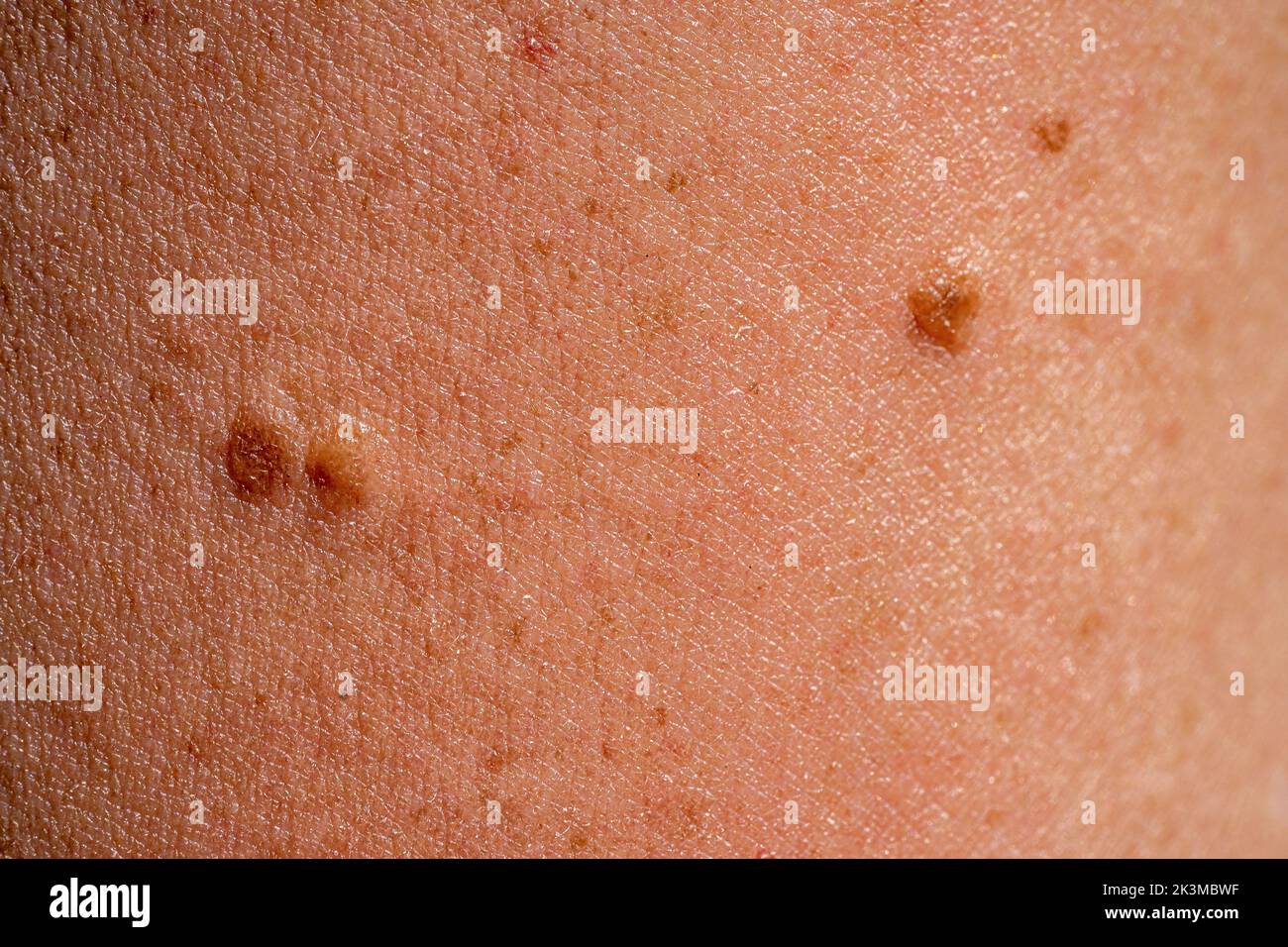 A macro shot of the human skin with nevi, moles. Stock Photo