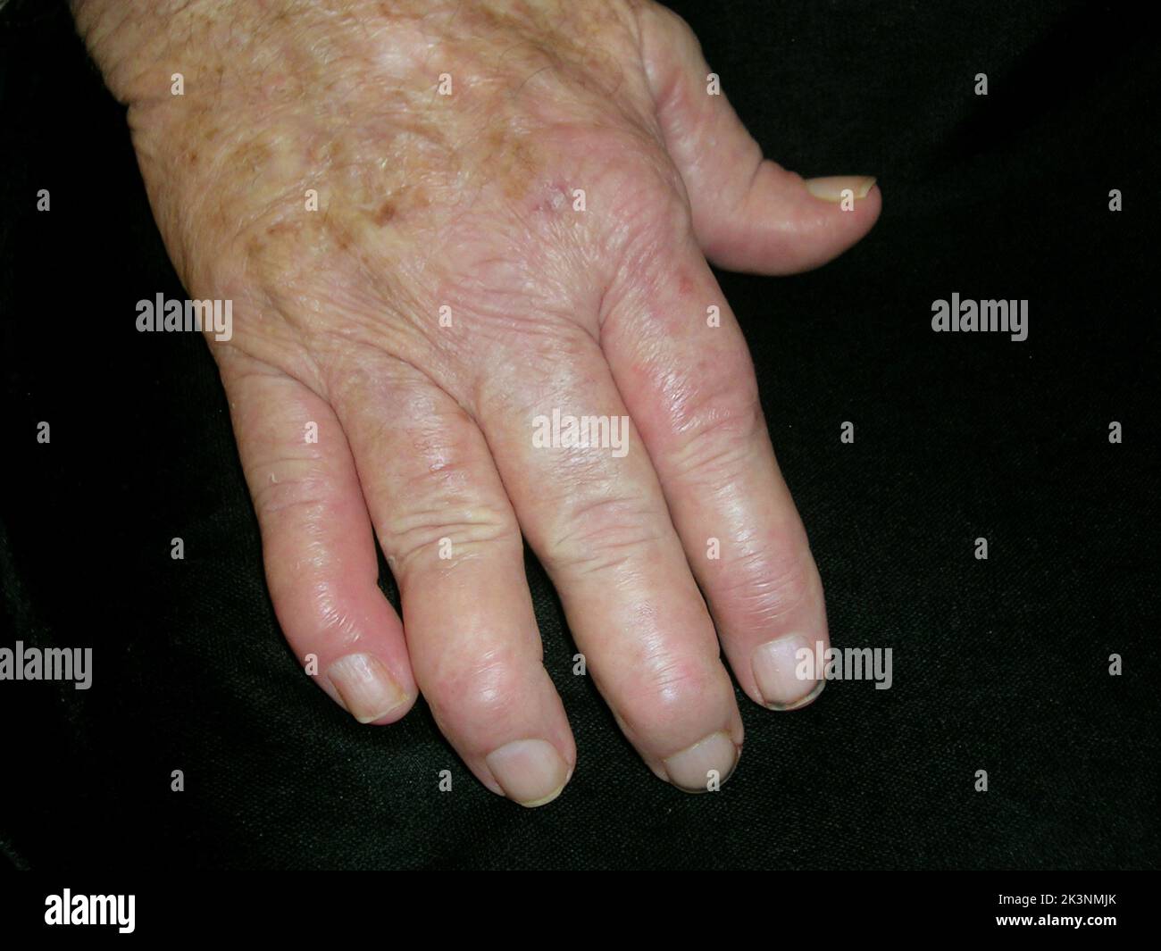 Rheumatoid arthritis nodules Stock Photo Alamy