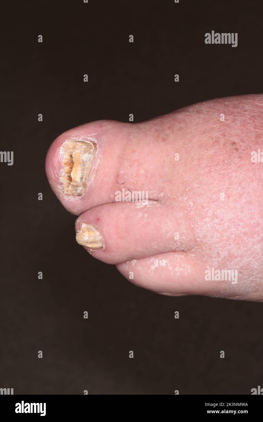 Congenital absence of two toes Stock Photo - Alamy