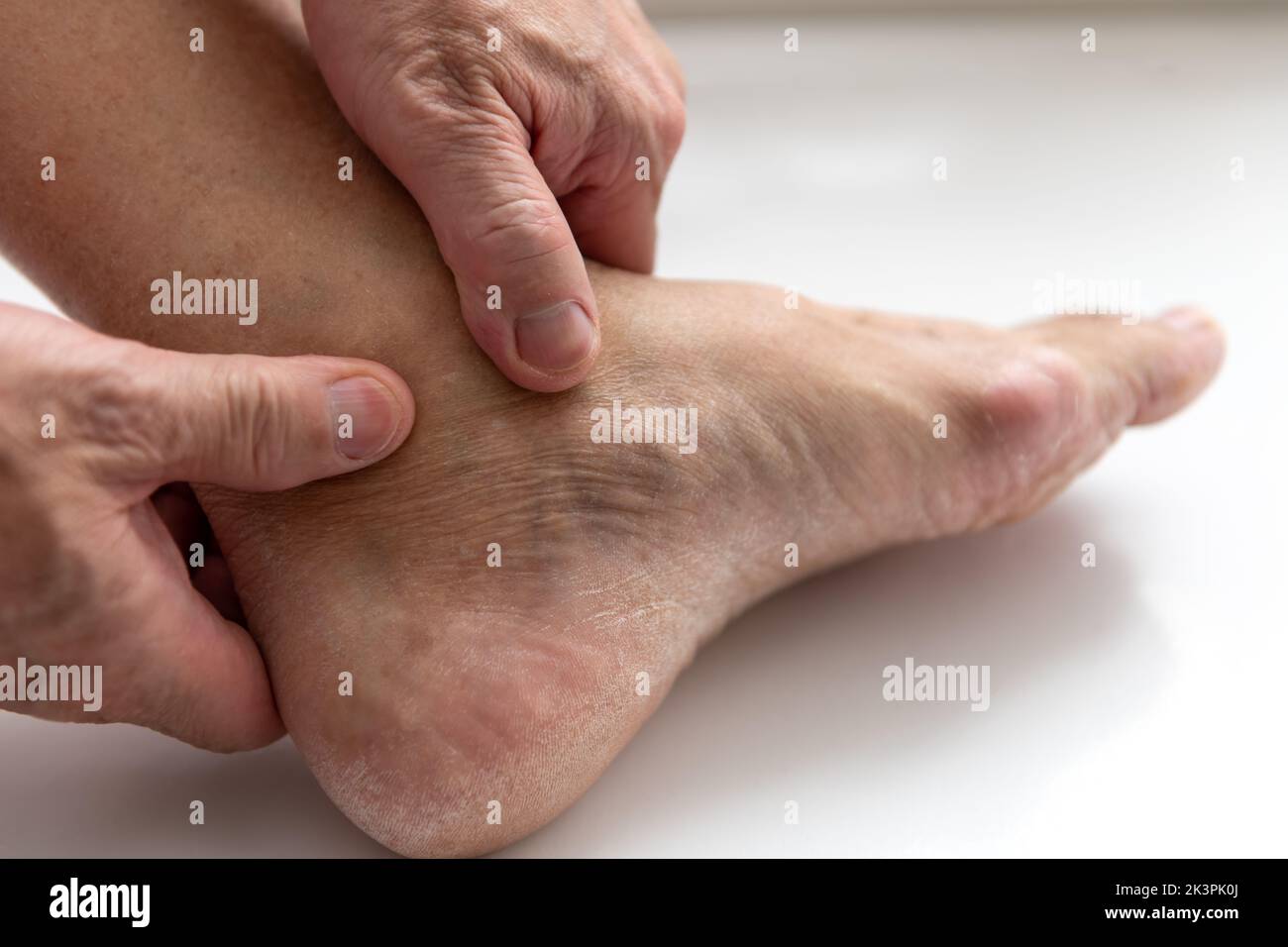 A person massaging foot ankle joint suffering from arthritis. Stock Photo