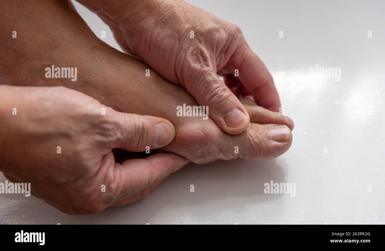 A person suffering from gout pain in the toe joint. Stock Photo