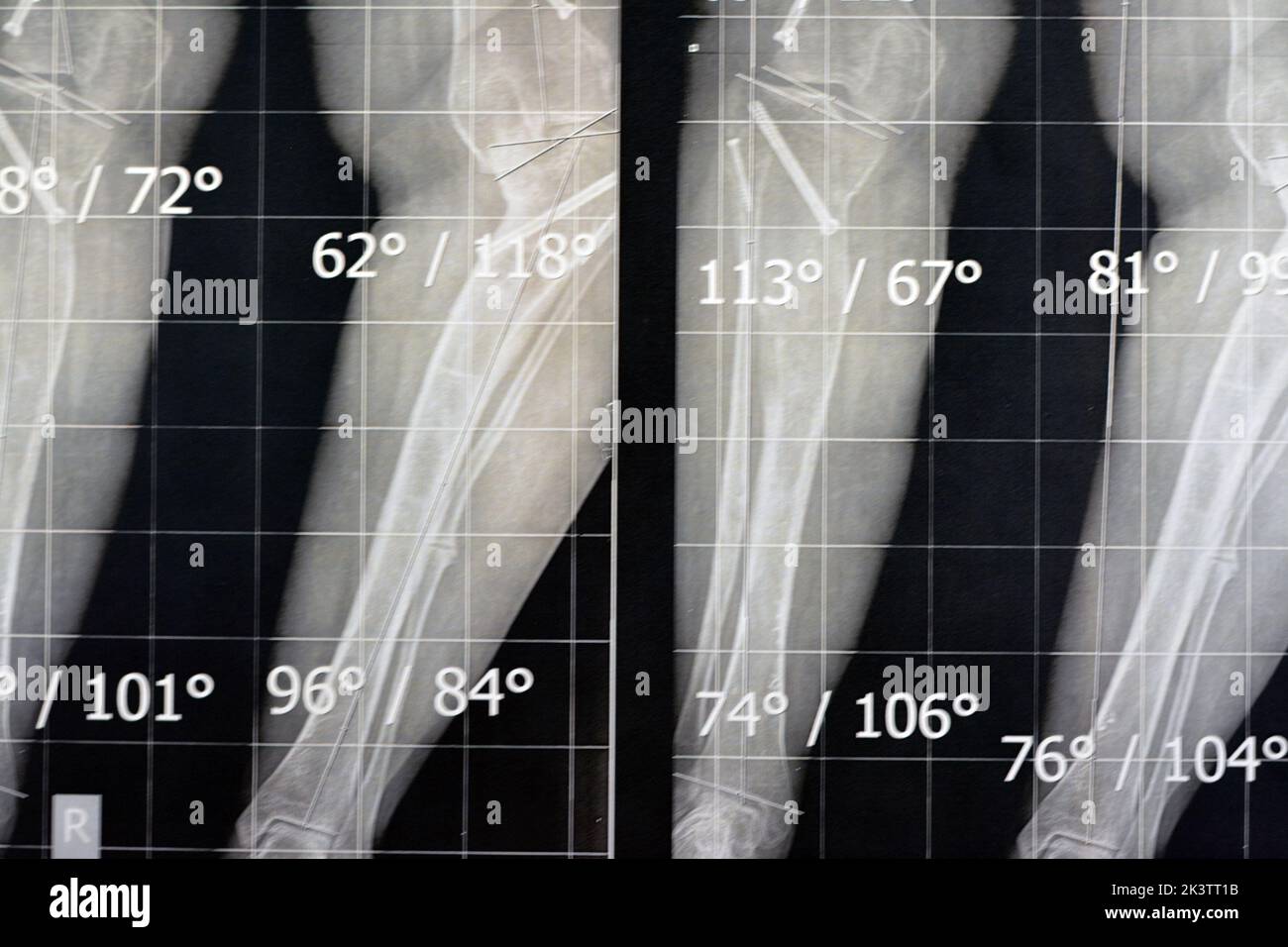 Plain X Ray Long Film Standing Position Showing Both Legs With