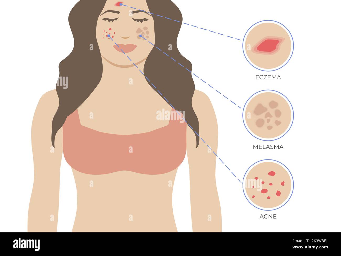 Skin Issues Eczema, Acne and Melasma. Skin Problems with Woman