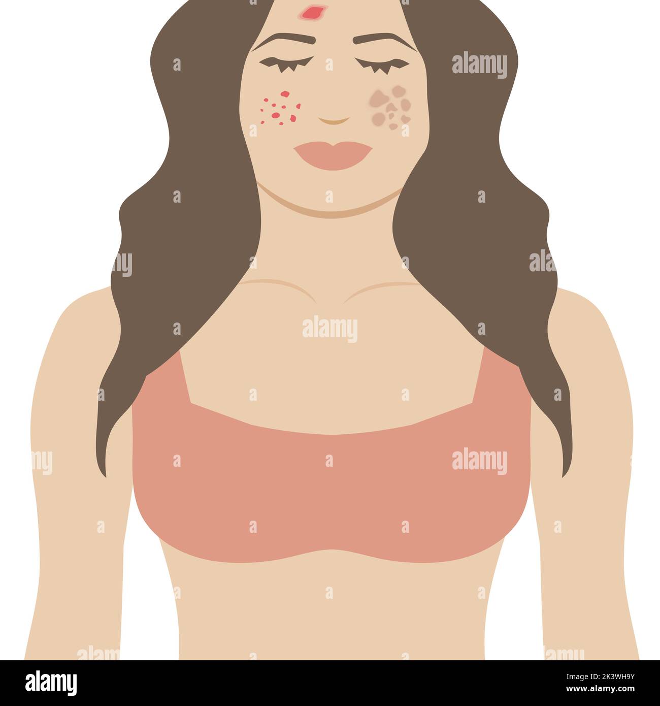 Melasma Stock Vector Images Alamy melasma-stock-vector-images-alamy