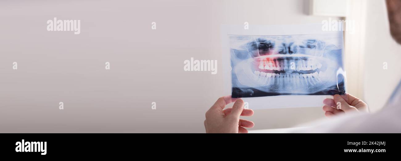 Wisdom Teeth Dental X Ray. Dentist Radiologist Doctor Stock Photo Alamy