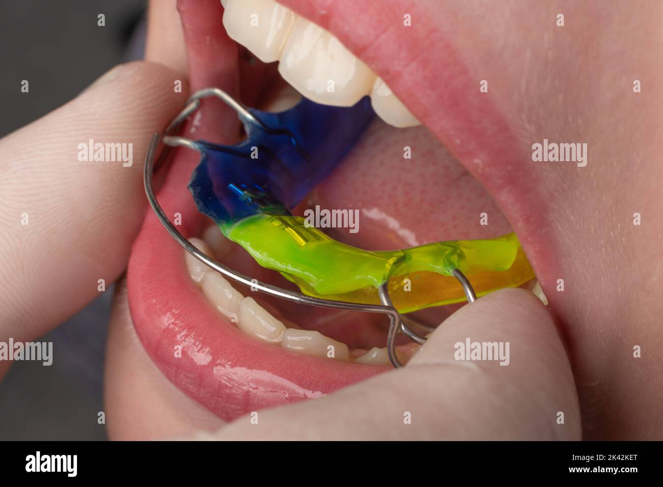 Plate for lower teeth, orthodontist and plate for teeth of the lower jaw, child and plate Stock