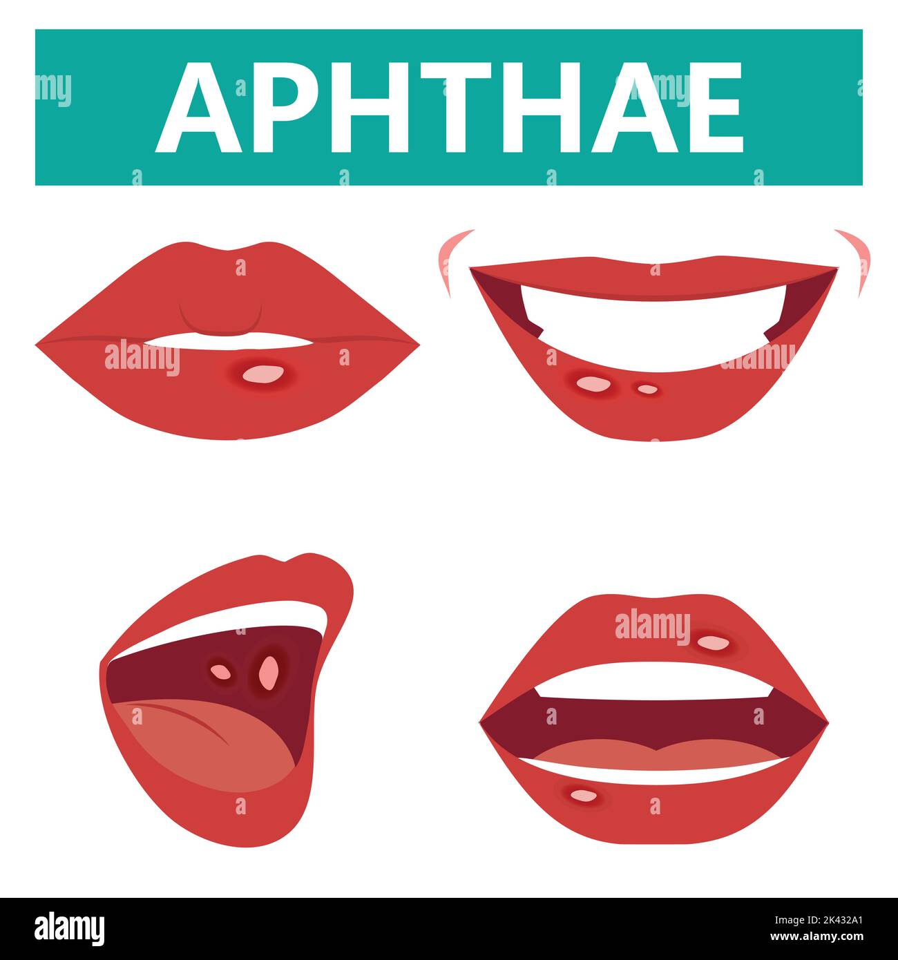 Aphthous ulcers on mouth close up,, vector illustration cartoon flat design clip art Stock Vector