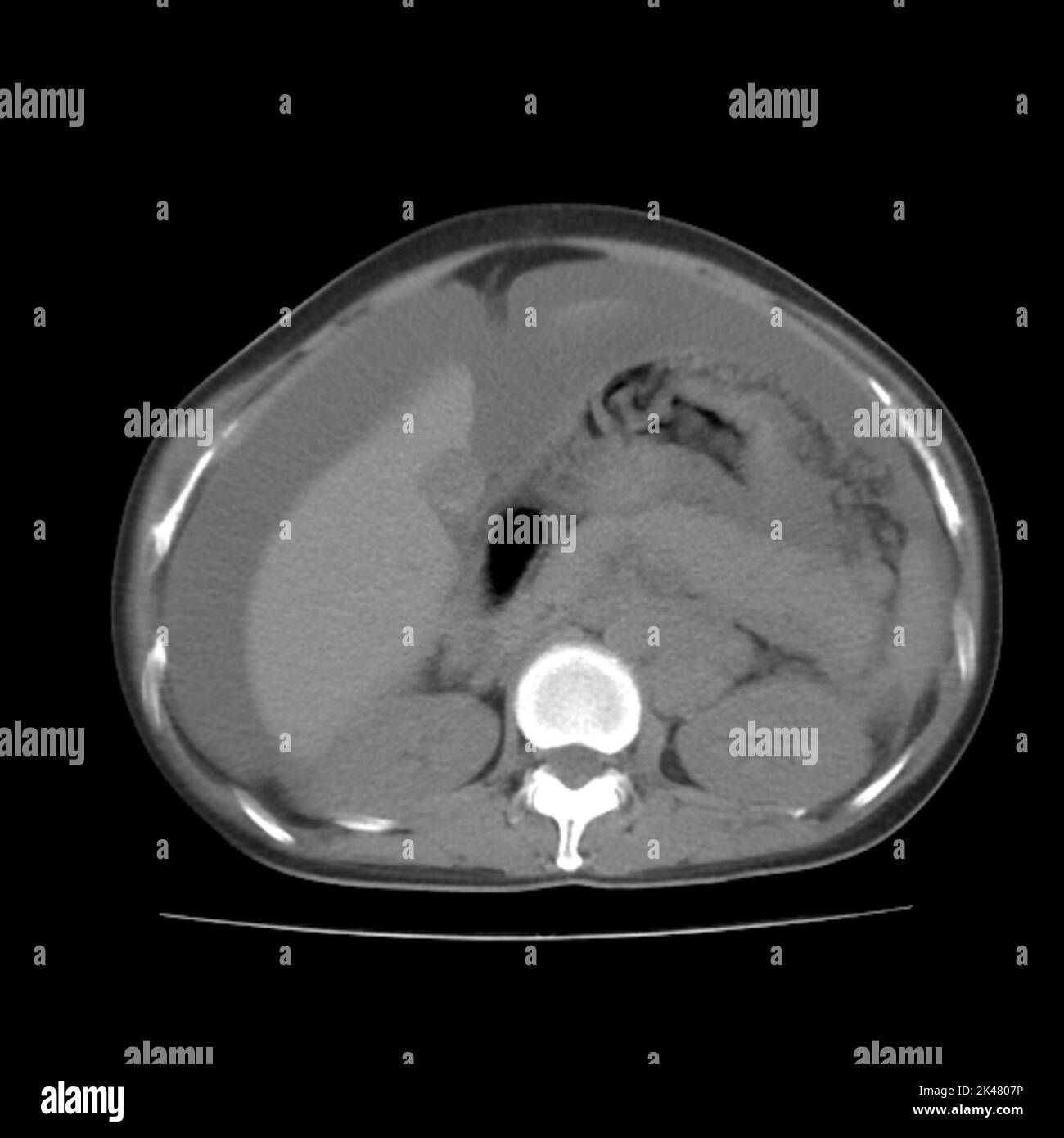 Ascites, CT scan Stock Photo