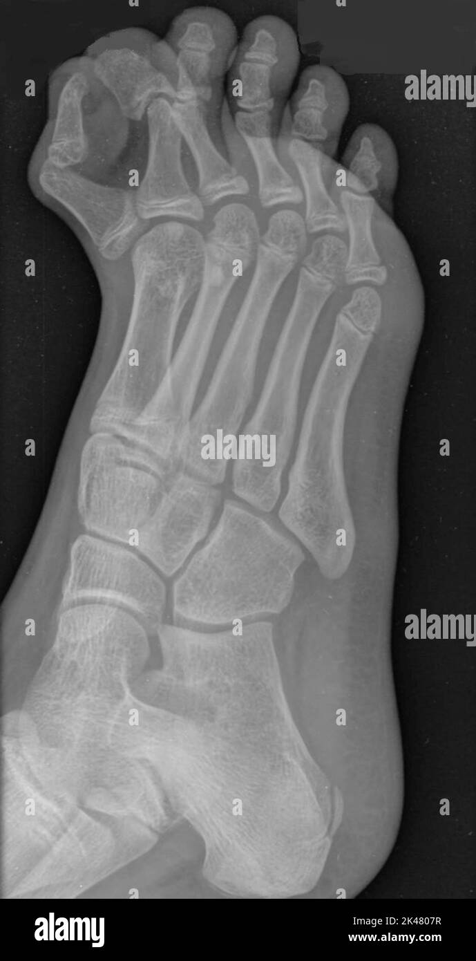 Extra toe, X-ray Stock Photo