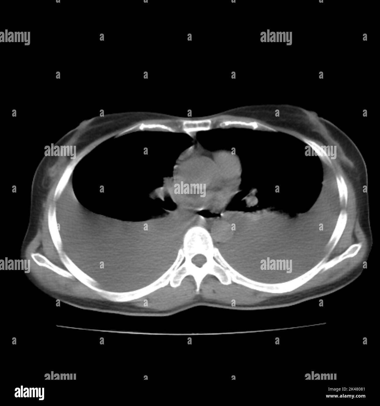 Pleural effusion, CT scan Stock Photo