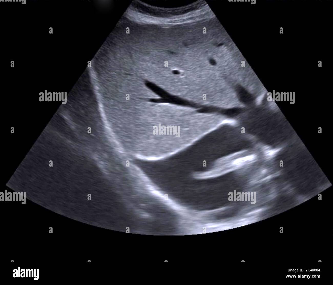 Pleural effusion ultrasound scan stock photo alamy