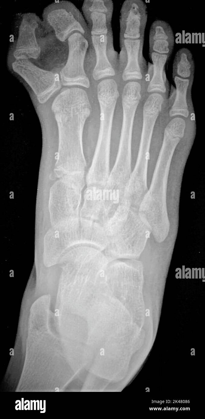 Extra toe, Xray Stock Photo Alamy